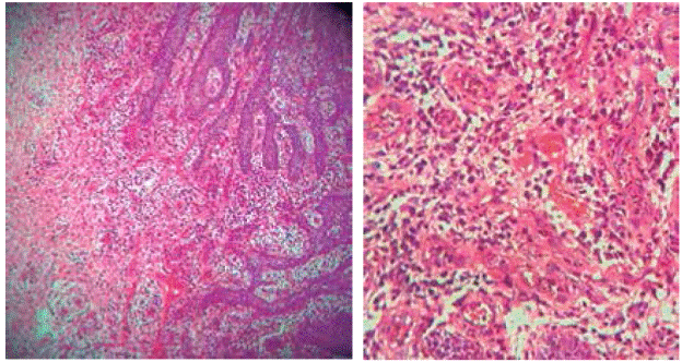 Pyogenic Granuloma Oral Cavity Histology