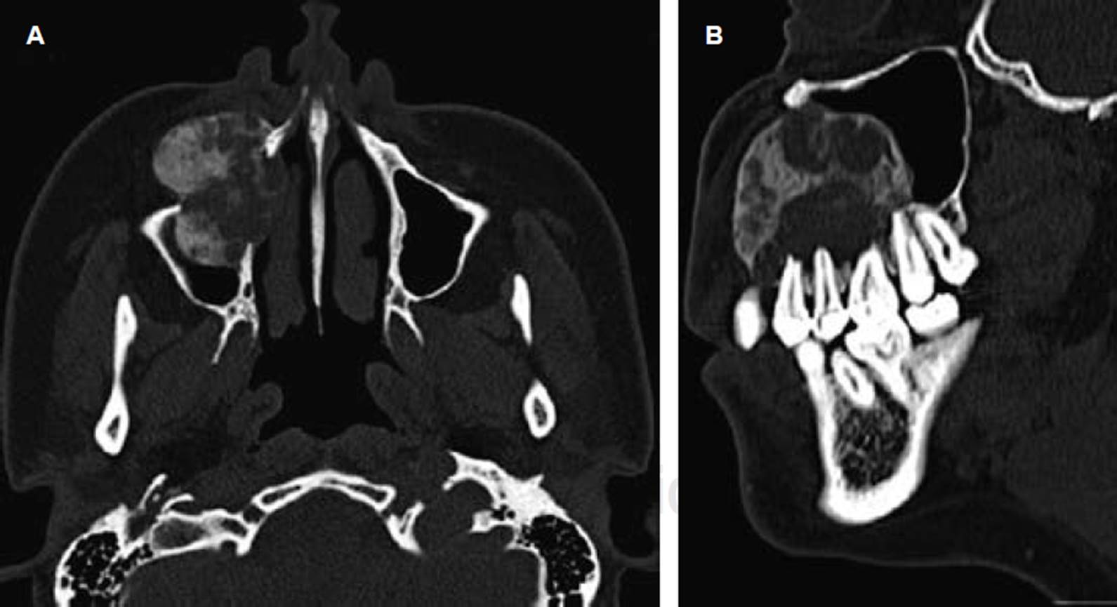 
							Computed tomography. A) Axial section showing mixed
								image pathology in the maxillary sinus area. B) The
								same lesion in sagittal section. It is appreciated almost completely
								occupying the anterior portion of the maxillary sinus and the
								relationship with the teeth up to the upper molars on the right
								side.
						