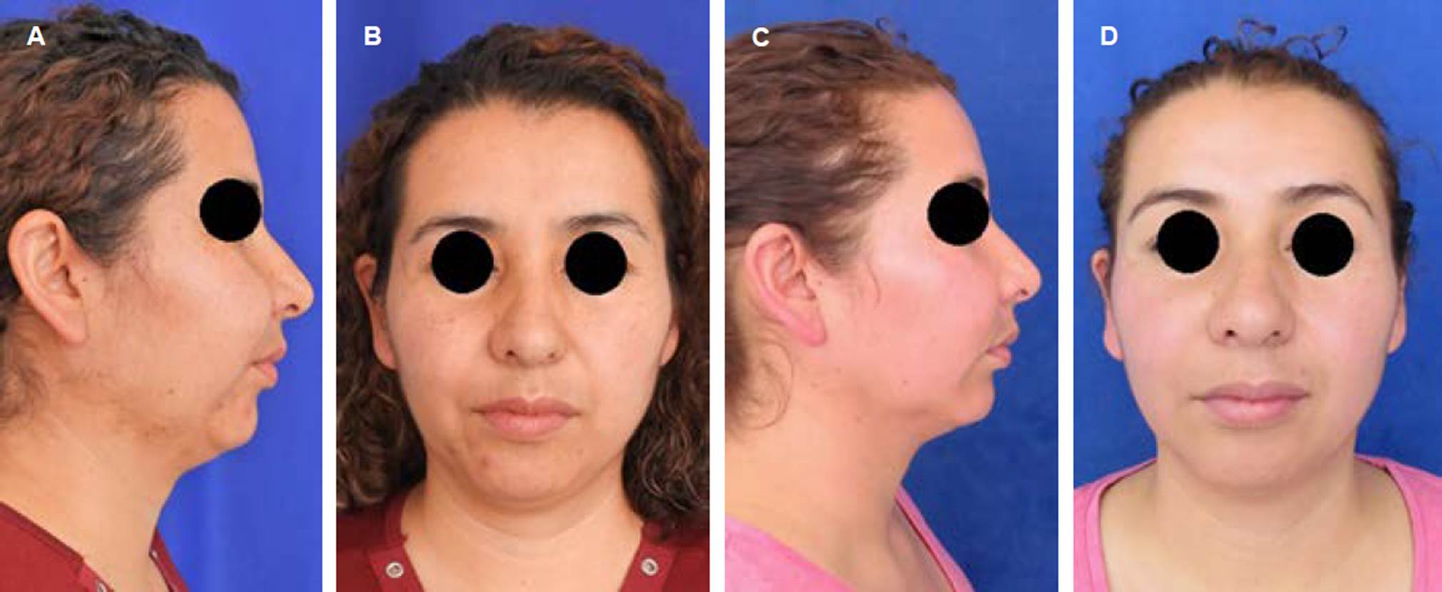 
							Comparative facial photos. Right (A) and frontal
									(B) profile before starting infiltration therapy
								with triamcinolone. Right (C) and frontal
									(D) profile after six weeks of corticosteroid
								application, with a slight decrease in the increase in
								volume.
						