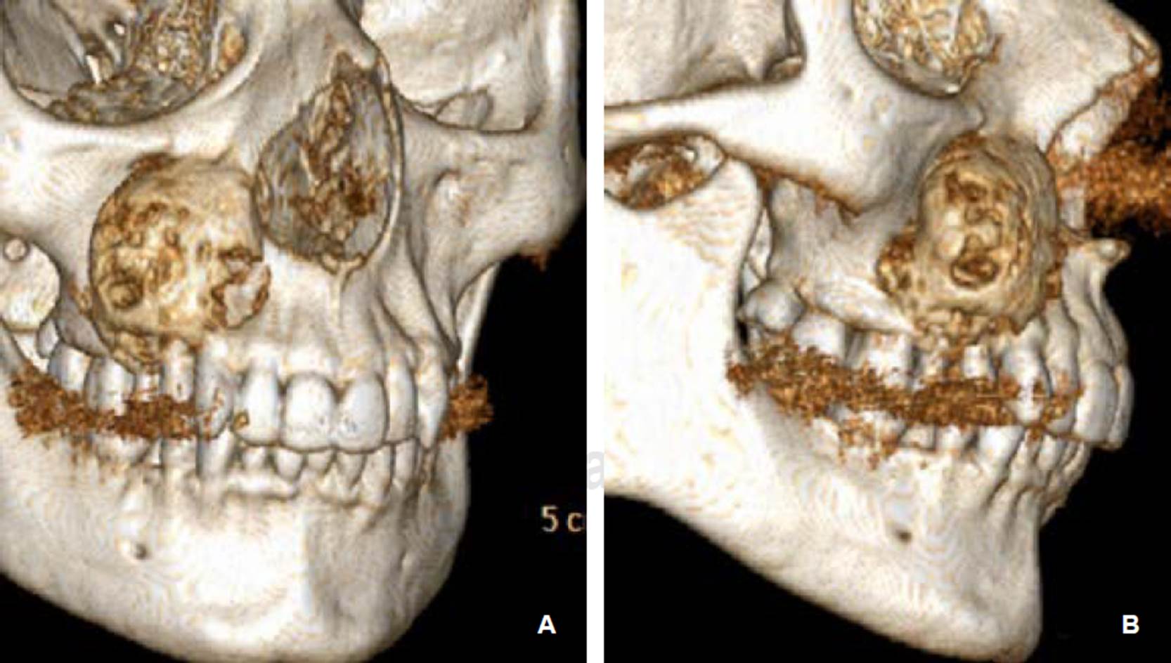 
							Trans-surgical photographs. A) Completely removed
								lesion. B) Clean surgical bed, with no lesion
								remains.
						