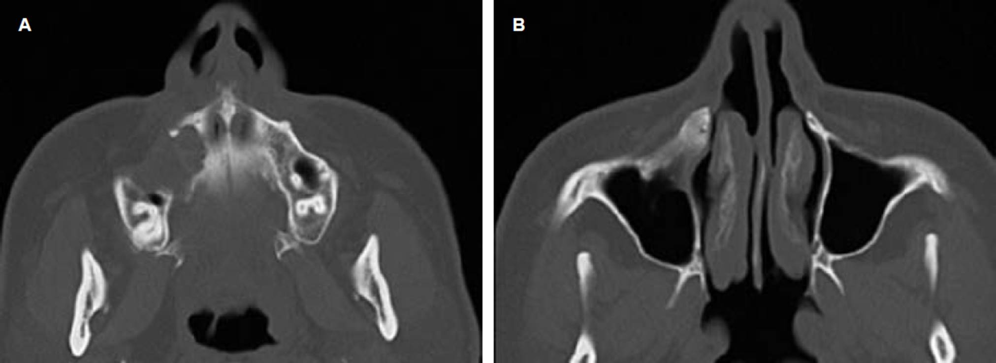 
							Control tomography one year after surgery. A) Axial
								section at the level of the maxillary alveolar process.
									B) At the level of the maxillary sinus. Both images
								show remodeling and proliferation of bone tissue.
						