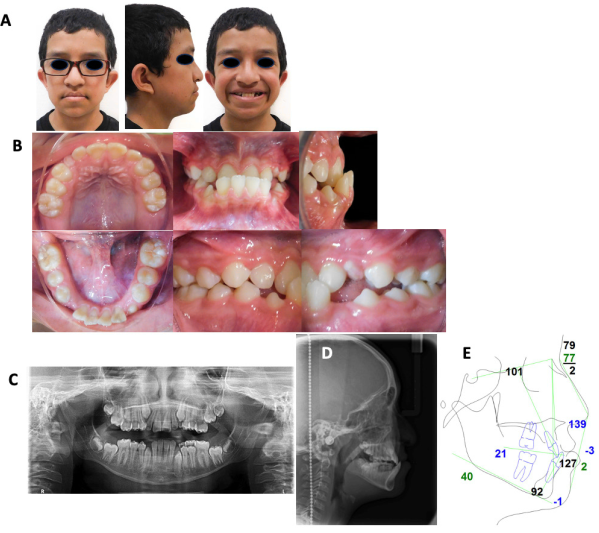 
							Initial studies. A. Extraoral photographs. B. Intraoral photographs, showing the level of crowding, anterior crossbite, overjet and overbite. C. Orthopantomography. D. Lateral cranial radiography. E. Initial Steiner cephalometric tracing performed in Dolphin Imaging Software version 11.0.
						