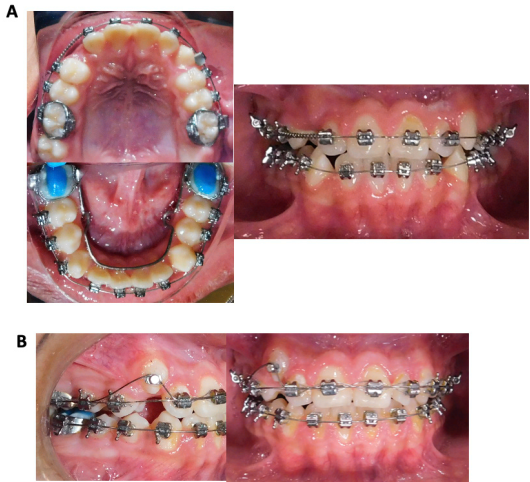 
							Treatment progress. A. Placement of springs and build-ups. B. Intraoral photographs showing the beginning of traction on tooth 13 with a button and a flexible archwire.
						