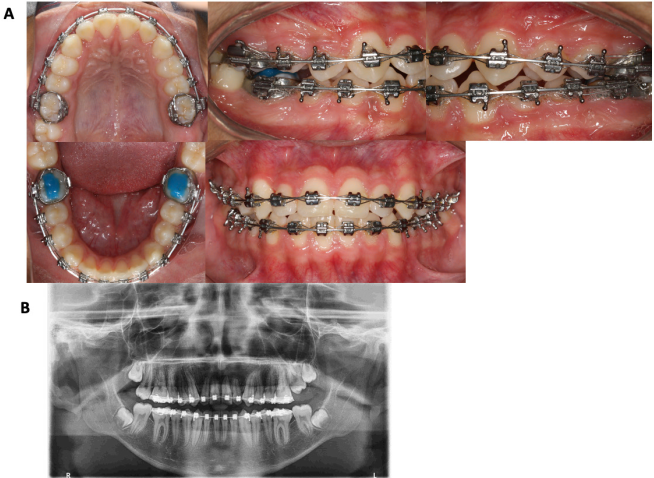
							treatment progress. a. 0.018” x 0.025” nitinol archwire and ligation of teeth 6 to 6. b. advance orthopantomography for repositioning of maxillary and mandibular canine and first premolar brackets.
						