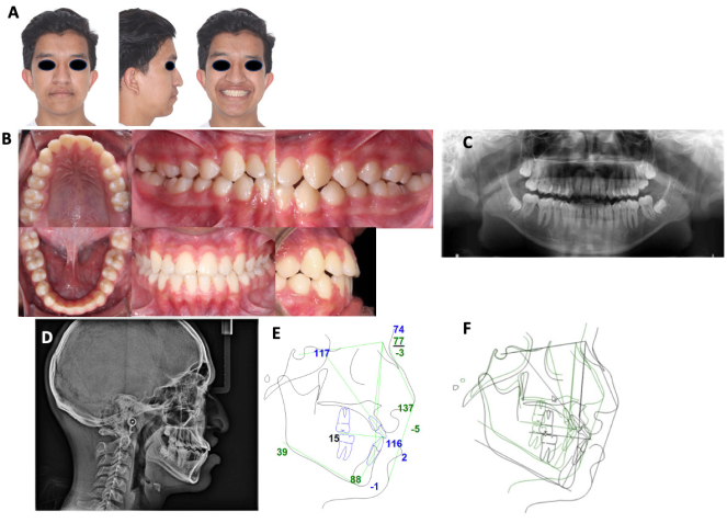 
							Final studies A. Extraoral photographs. B. Intraoral photographs and canine guidance. C. Orthopantomography. D. Final lateral cranial radiography. E. Steiner cephalometric tracing. F. Superimposition.
						